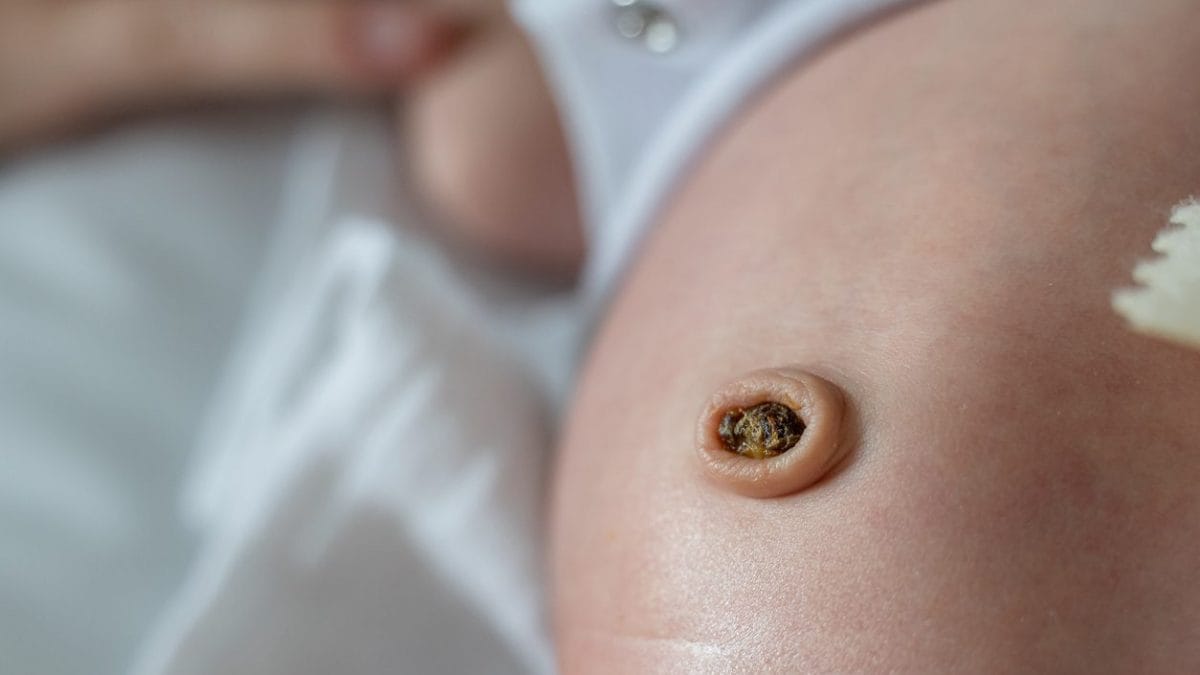 granuloma ombelicale