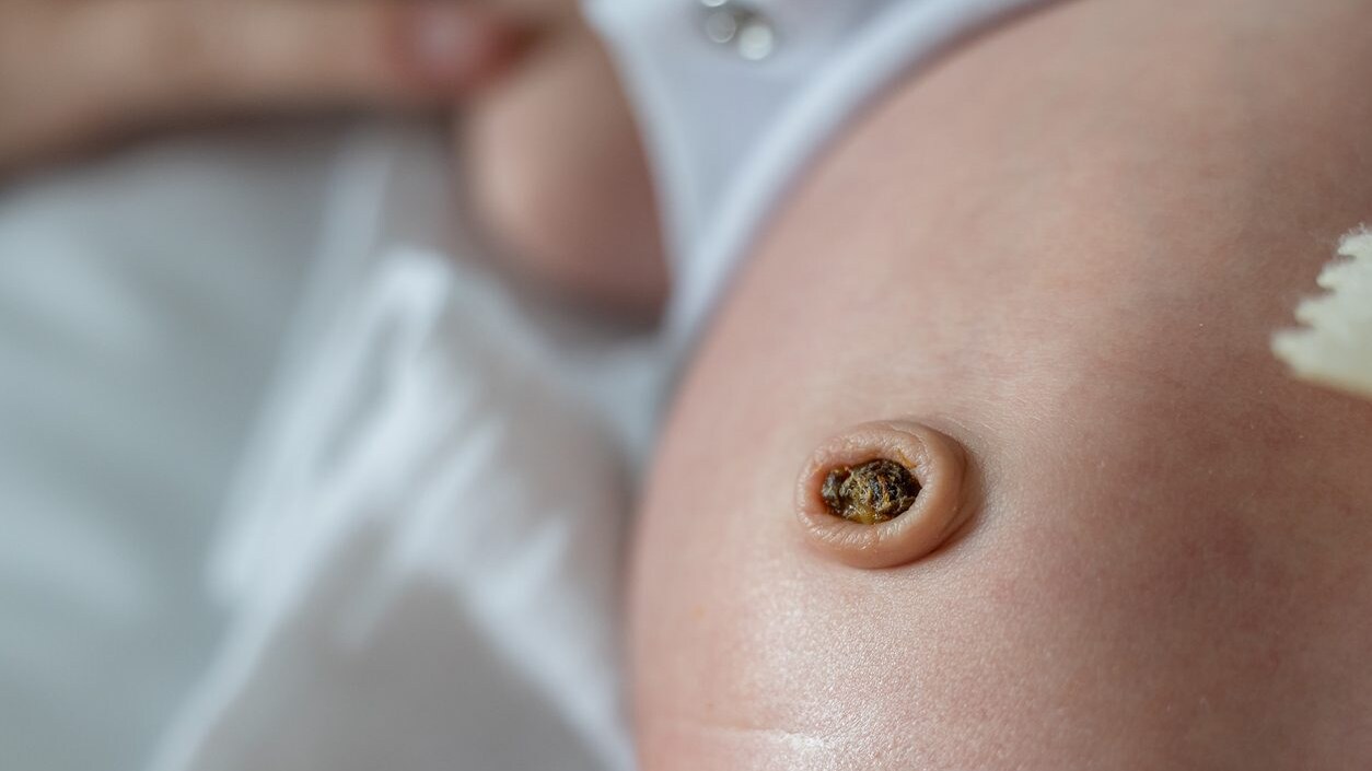 granuloma ombelicale