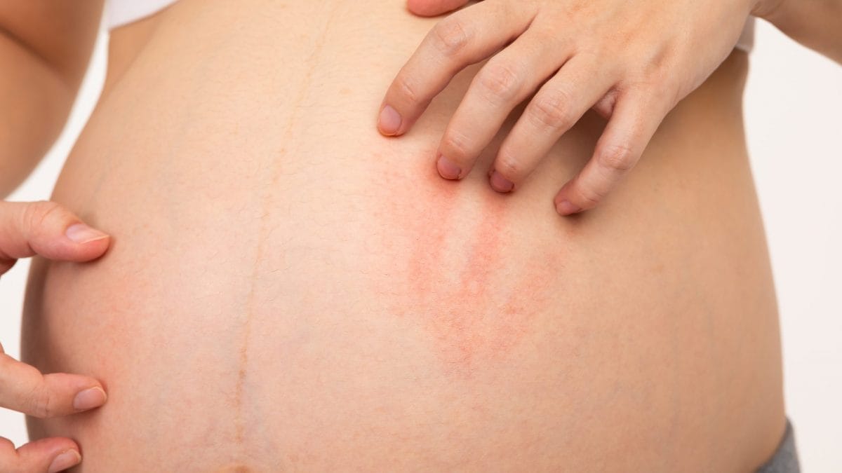 prurito in gravidanza