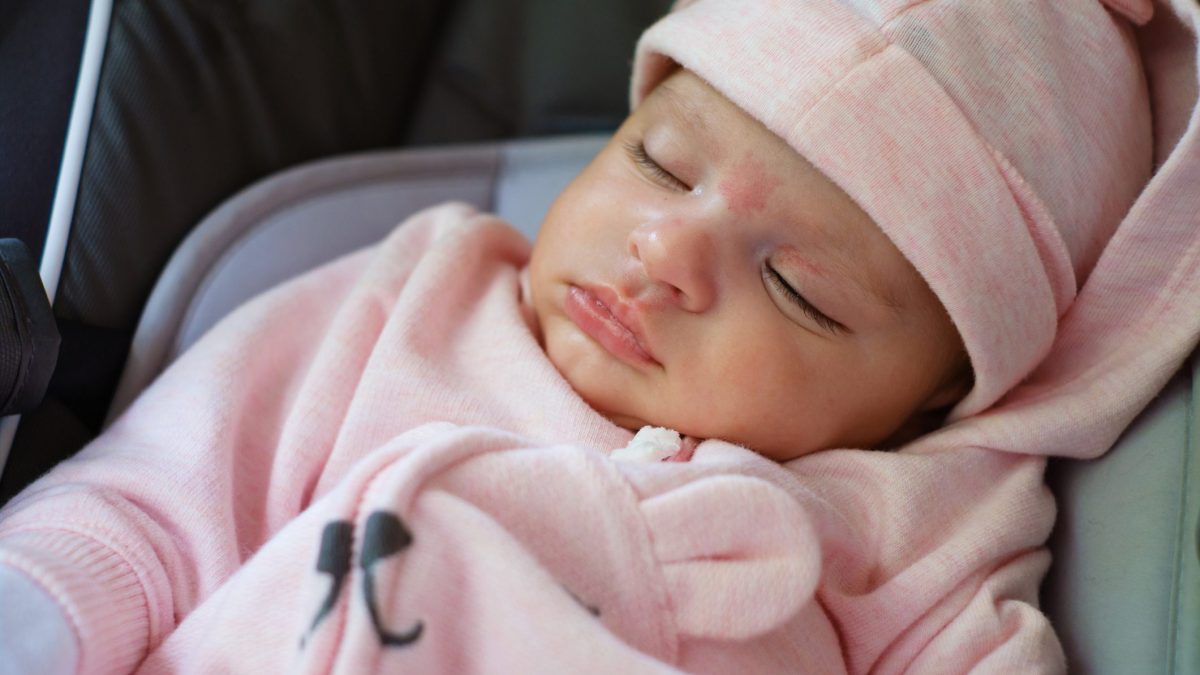 angioma della cicogna