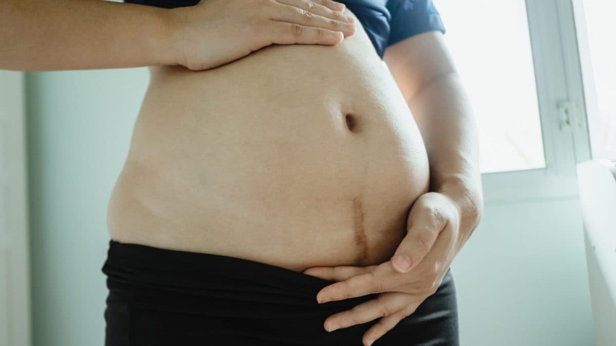 parto naturale dopo cesareo