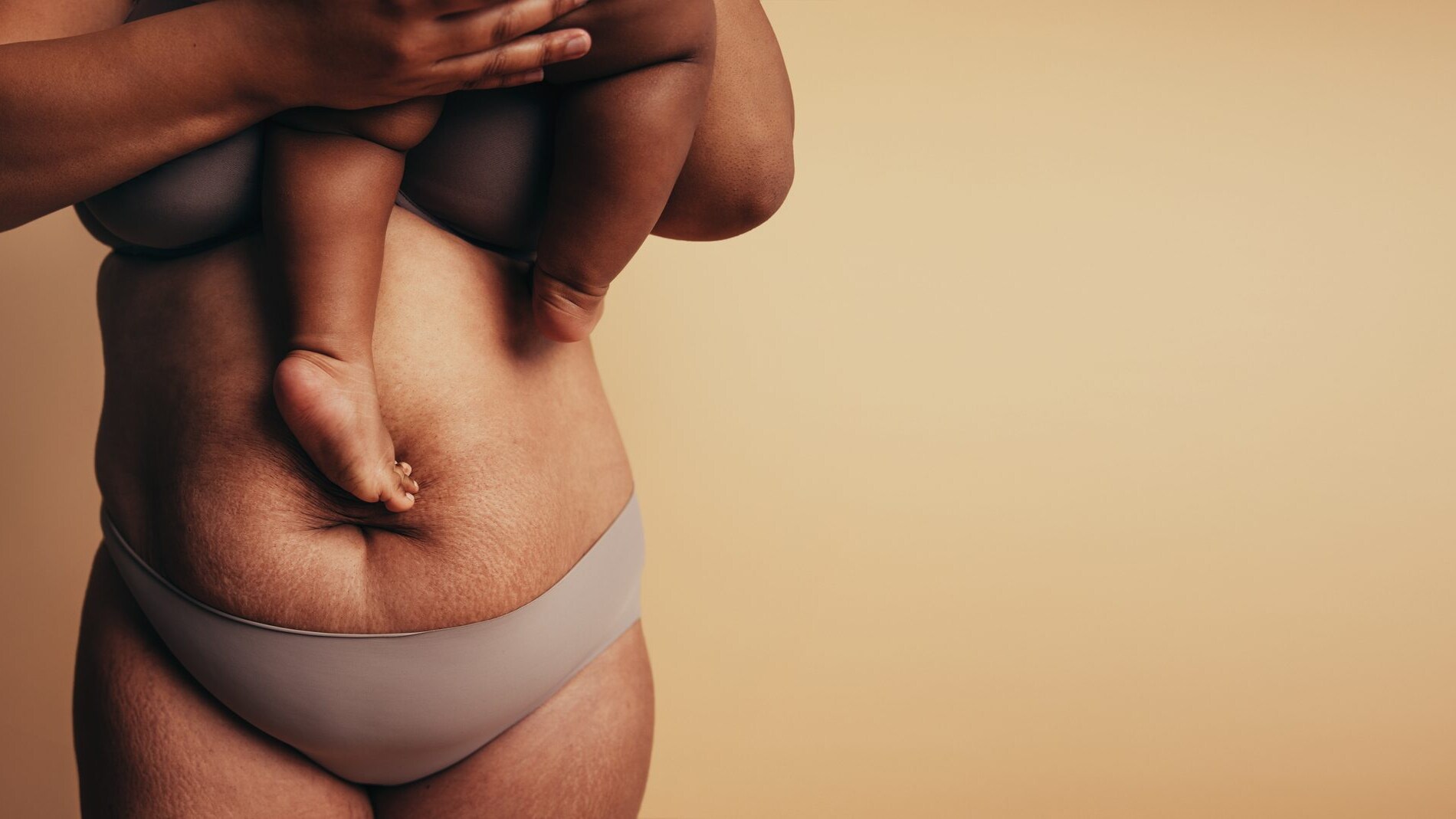 smagliature in gravidanza