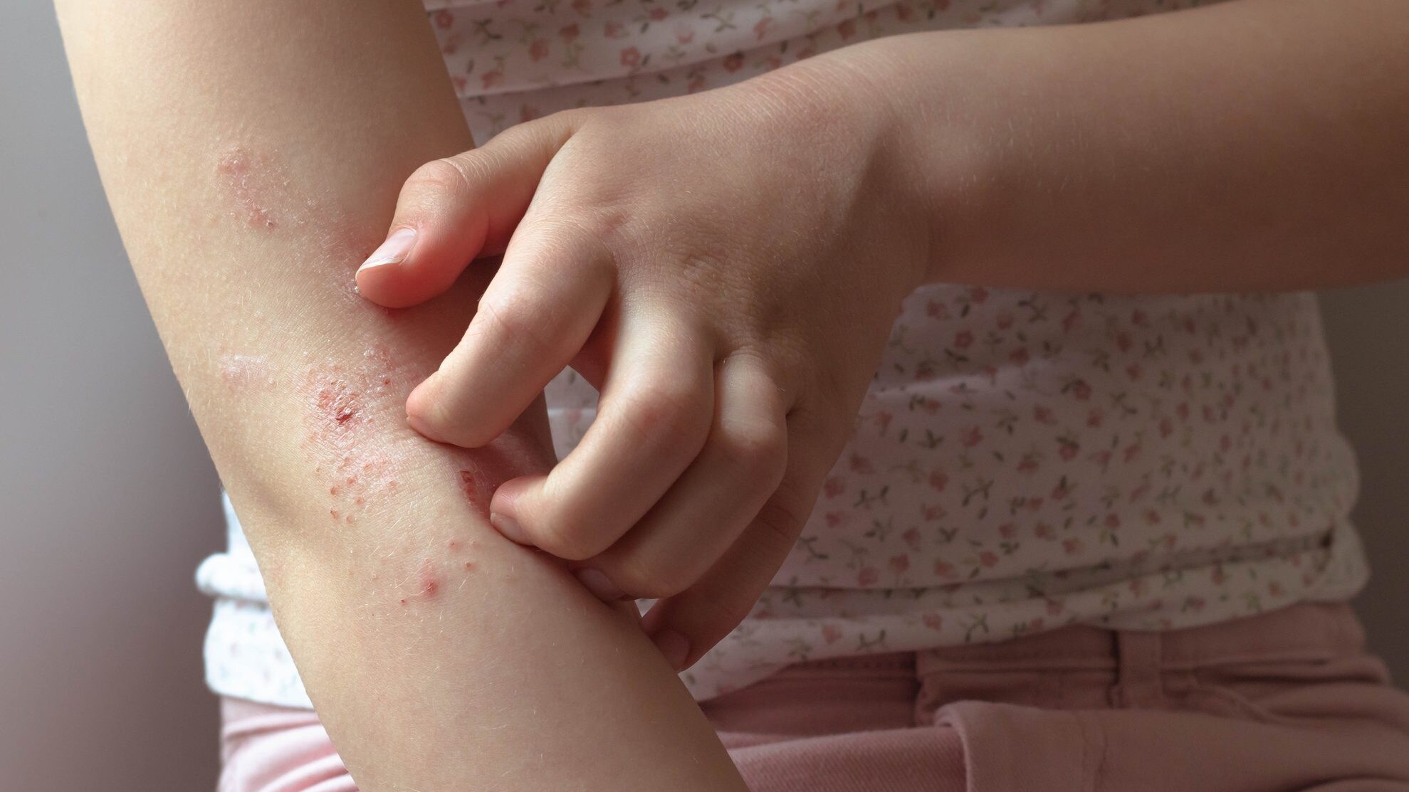 impetigine