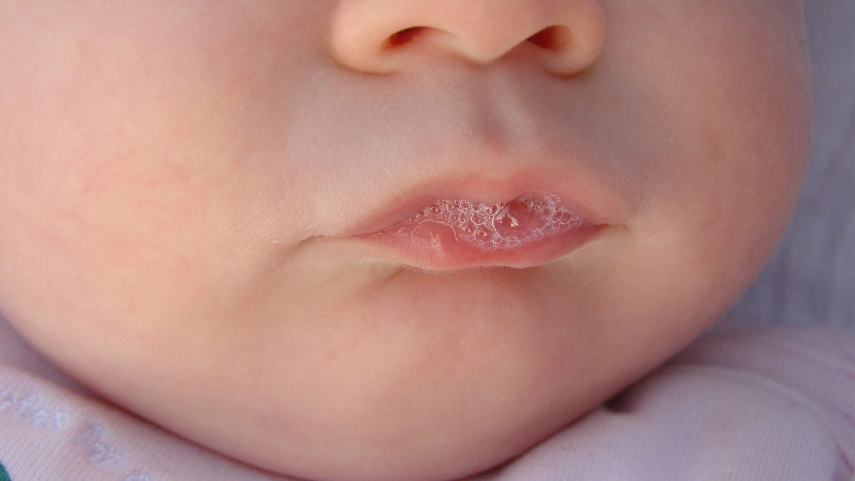 bollicine bocca neonato