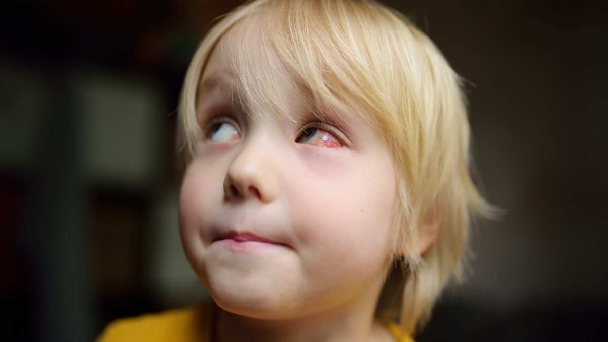 congiuntivite nei bambini