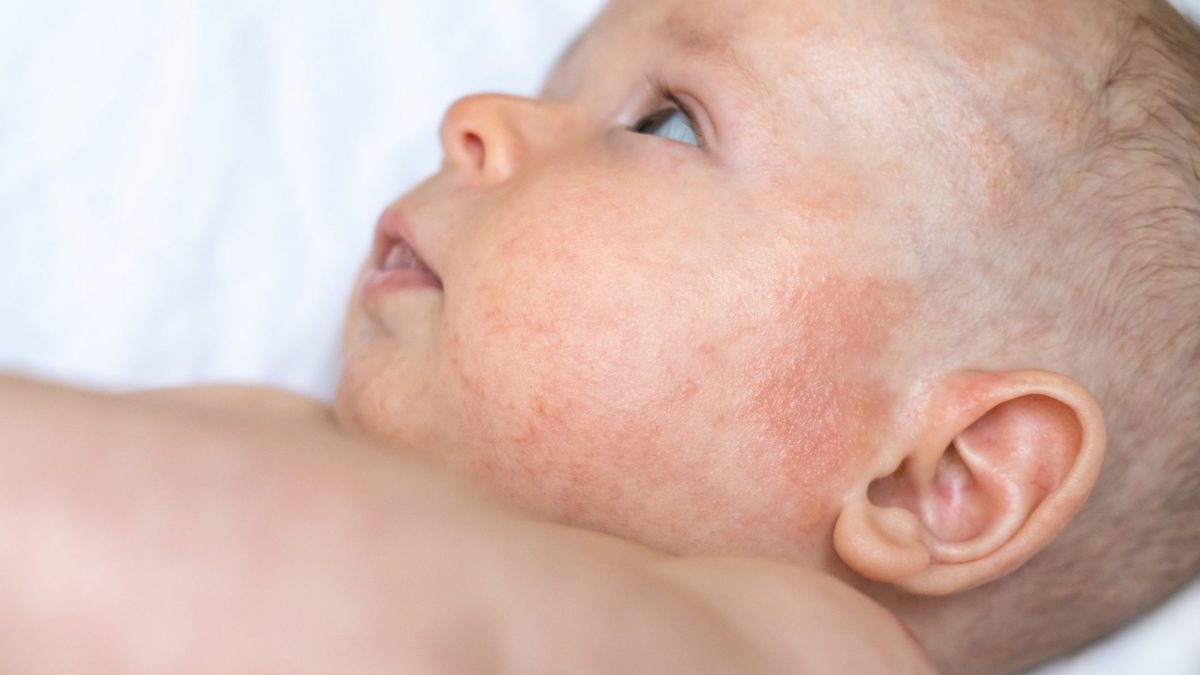 neonato pelle screpolata