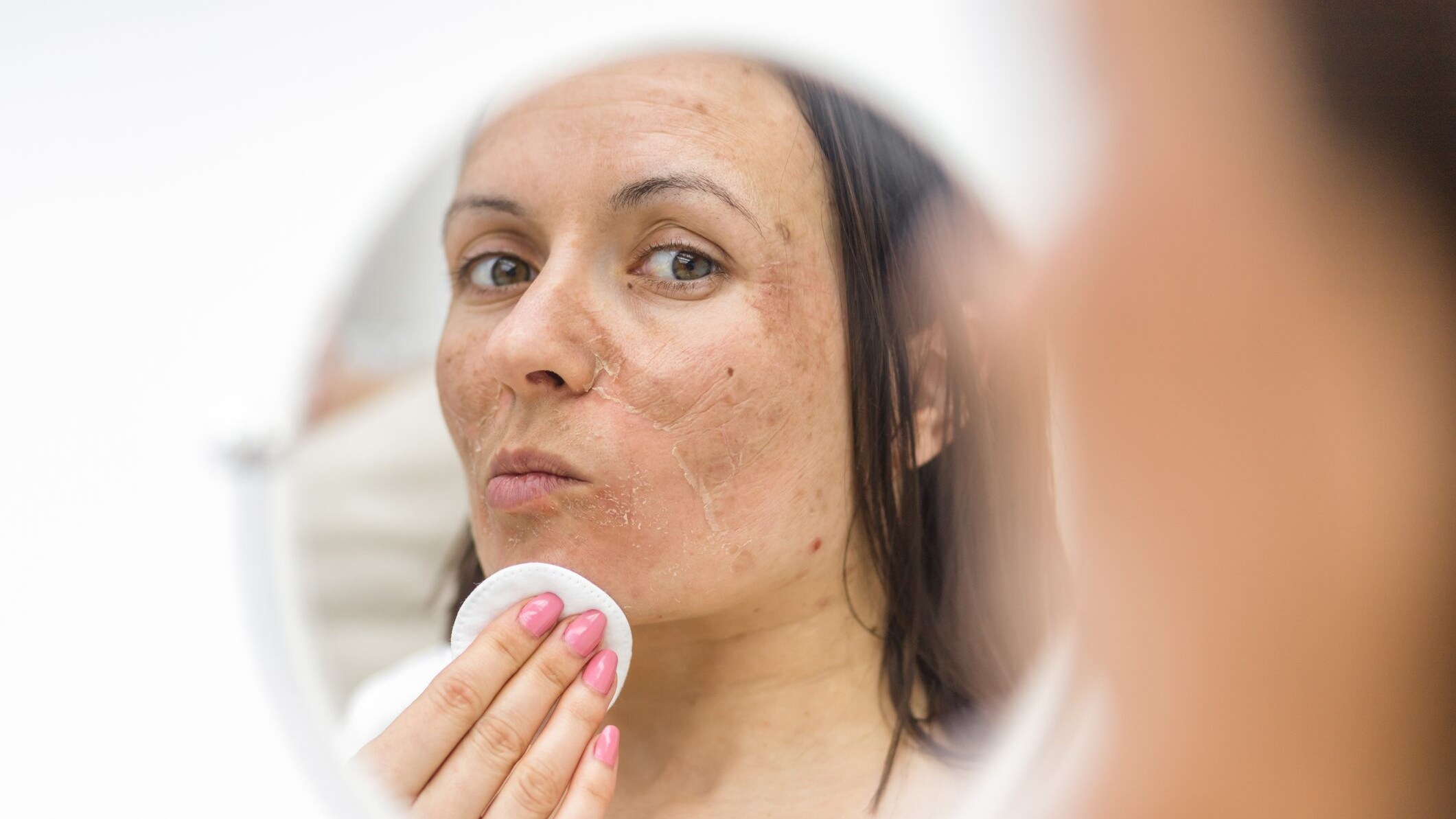 melasma gravidanza