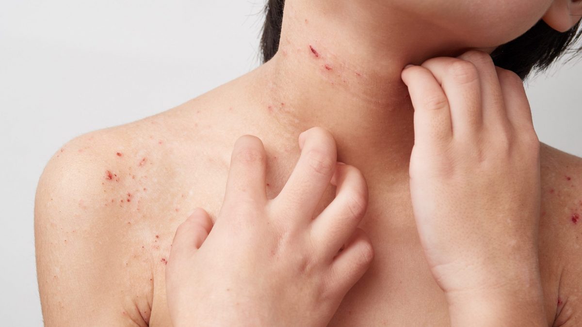 dermatite atopica nei bambini