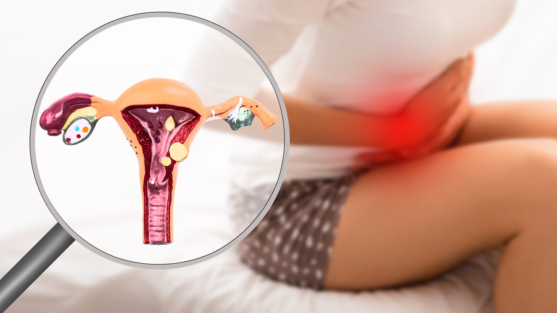 endometriosi