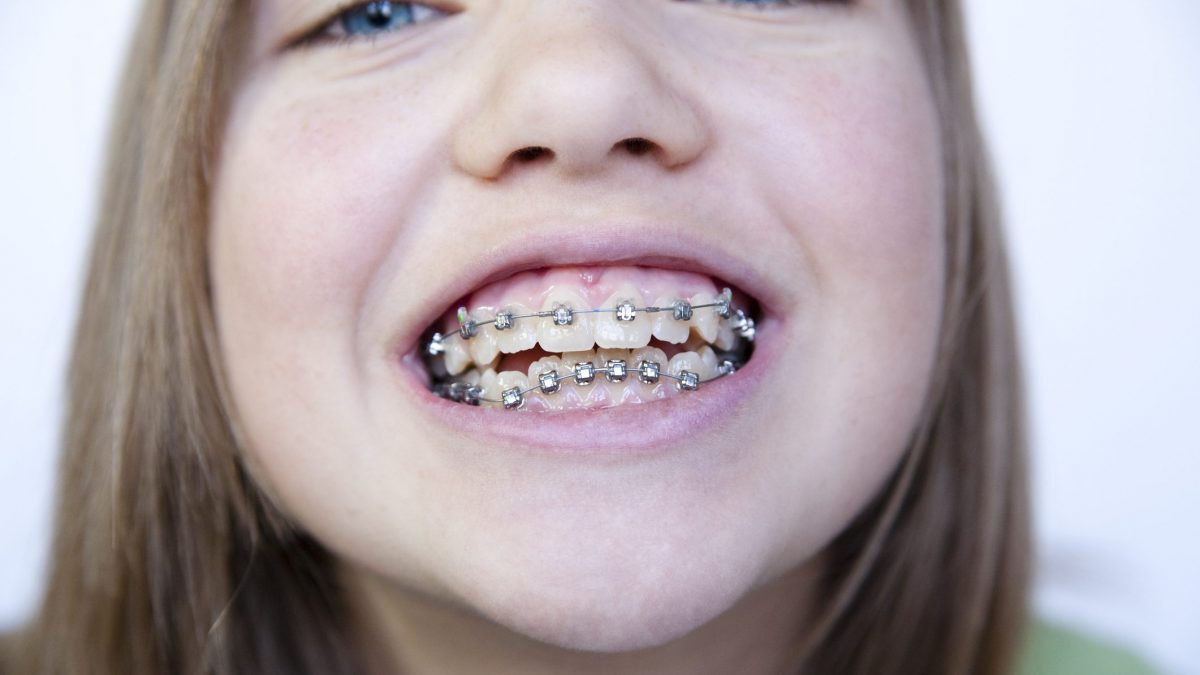 apparecchio ai denti